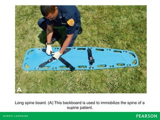 Long spine board. (A) This backboard is used to immobilize the spine of a
supine patient.
 