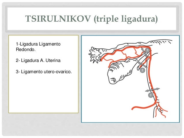 En Una Triple Ligadura Se Unen