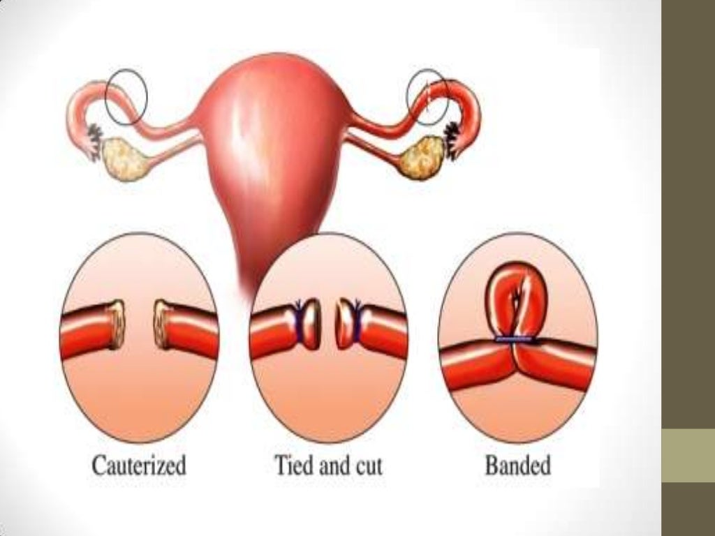 Ligaduras de trompas