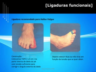 Hugo Pedrosa 2009 [Ligaduras funcionais] Ligadura recomendada para Hallux Valgus Construção: Colocamos TAPE ( 1,5 cm ) na  parte interna do dedo do pé  com tensão suficiente para  corrigir o ângulo externo do dedo Depois colocar duas ou três tiras em função da tensão que se quer obter. 