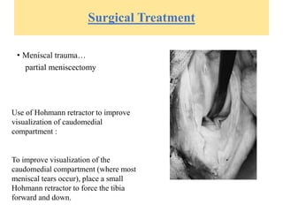 Surgical Treatment
• Meniscal trauma…
partial meniscectomy
Use of Hohmann retractor to improve
visualization of caudomedial
compartment :
To improve visualization of the
caudomedial compartment (where most
meniscal tears occur), place a small
Hohmann retractor to force the tibia
forward and down.
 