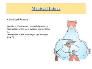 Meniscal Injury
• Meniscal Release
Locations of release of the medial meniscus.
Transection of the meniscotibial ligament (line
A).
Transection of the midbody of the meniscus
(line B).
 