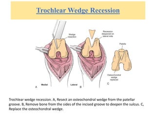 Trochlear Wedge Recession
Trochlear wedge recession. A, Resect an osteochondral wedge from the patellar
groove. B, Remove bone from the sides of the incised groove to deepen the sulcus. C,
Replace the osteochondral wedge.
 