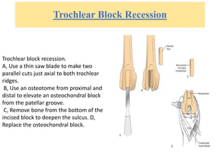 Trochlear Block Recession
Trochlear block recession.
A, Use a thin saw blade to make two
parallel cuts just axial to both trochlear
ridges.
B, Use an osteotome from proximal and
distal to elevate an osteochondral block
from the patellar groove.
C, Remove bone from the bottom of the
incised block to deepen the sulcus. D,
Replace the osteochondral block.
 