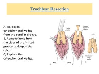 Trochlear Resection
A, Resect an
osteochondral wedge
from the patellar groove.
B, Remove bone from
the sides of the incised
groove to deepen the
sulcus.
C, Replace the
osteochondral wedge.
 
