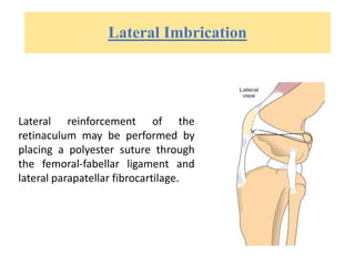 Lateral Imbrication
Lateral reinforcement of the
retinaculum may be performed by
placing a polyester suture through
the femoral-fabellar ligament and
lateral parapatellar fibrocartilage.
 