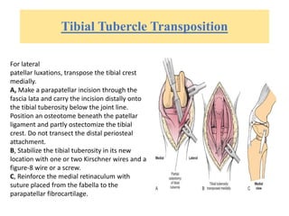 Tibial Tubercle Transposition
For lateral
patellar luxations, transpose the tibial crest
medially.
A, Make a parapatellar incision through the
fascia lata and carry the incision distally onto
the tibial tuberosity below the joint line.
Position an osteotome beneath the patellar
ligament and partly ostectomize the tibial
crest. Do not transect the distal periosteal
attachment.
B, Stabilize the tibial tuberosity in its new
location with one or two Kirschner wires and a
figure-8 wire or a screw.
C, Reinforce the medial retinaculum with
suture placed from the fabella to the
parapatellar fibrocartilage.
 