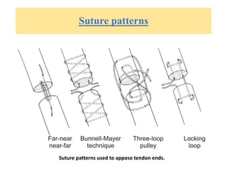 Suture patterns
Suture patterns used to appose tendon ends.
 