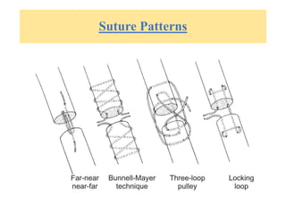 Suture Patterns
 
