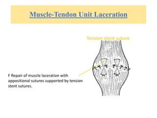 Muscle-Tendon Unit Laceration
Tension stent suture
F Repair of muscle laceration with
appositional sutures supported by tension
stent sutures.
 