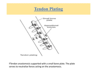 Tendon Plating
FTendon anastomosis supported with a small bone plate. The plate
serves to neutralize forces acting on the anastomosis.
 