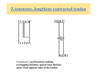 Z-tenotomy..lengthens contracted tendon
Z-tenotomy is performed by making
overlapping incisions, spaced some distance
apart, from opposite sides of the tendon.
 