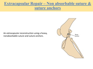 Extracapsular Repair – Non absorbable suture &
suture anchors
An extracapsular reconstruction using a heavy,
nonabsorbable suture and suture anchors.
 