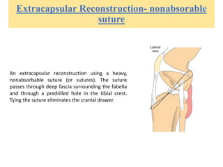 Extracapsular Reconstruction- nonabsorable
suture
An extracapsular reconstruction using a heavy,
nonabsorbable suture (or sutures). The suture
passes through deep fascia surrounding the fabella
and through a predrilled hole in the tibial crest.
Tying the suture eliminates the cranial drawer.
 