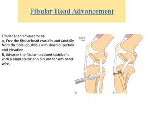 Fibular Head Advancement
Fibular head advancement.
A, Free the fibular head cranially and caudally
from the tibial epiphysis with sharp dissection
and elevation.
B, Advance the fibular head and stabilize it
with a small Steinmann pin and tension band
wire.
 