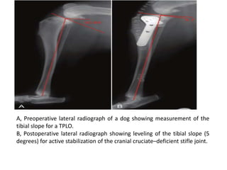 A, Preoperative lateral radiograph of a dog showing measurement of the
tibial slope for a TPLO.
B, Postoperative lateral radiograph showing leveling of the tibial slope (5
degrees) for active stabilization of the cranial cruciate–deficient stifle joint.
 