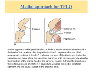 Medial approach for TPLO
Medial approach to the proximal tibia. A, Make a medial skin incision centered at
the level of the proximal tibia. Begin the incision 3 cm proximal to the tibial
plateau and continue it distally 5 cm below the level of the tibial crest. Incise the
subcutaneous tissue along the same line sharply or with electrocautery to visualize
the insertion of the cranial head of the sartorius muscle. B, Incise the insertion of
the sartorius muscle and reflect it caudally to visualize the medial collateral
ligament and the caudal aspect of the proximal tibia.
 