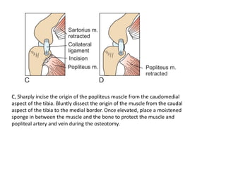 C, Sharply incise the origin of the popliteus muscle from the caudomedial
aspect of the tibia. Bluntly dissect the origin of the muscle from the caudal
aspect of the tibia to the medial border. Once elevated, place a moistened
sponge in between the muscle and the bone to protect the muscle and
popliteal artery and vein during the osteotomy.
 