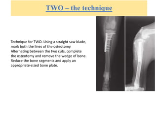 TWO – the technique
Technique for TWO. Using a straight saw blade,
mark both the lines of the osteotomy.
Alternating between the two cuts, complete
the osteotomy and remove the wedge of bone.
Reduce the bone segments and apply an
appropriate-sized bone plate.
 