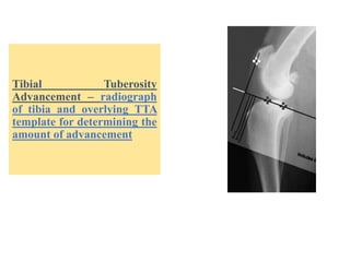 Tibial Tuberosity
Advancement – radiograph
of tibia and overlying TTA
template for determining the
amount of advancement
 