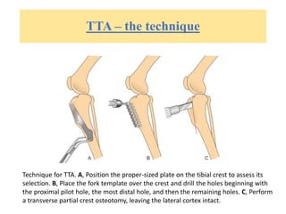 TTA – the technique
Technique for TTA. A, Position the proper-sized plate on the tibial crest to assess its
selection. B, Place the fork template over the crest and drill the holes beginning with
the proximal pilot hole, the most distal hole, and then the remaining holes. C, Perform
a transverse partial crest osteotomy, leaving the lateral cortex intact.
 