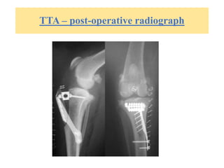 TTA – post-operative radiograph
 