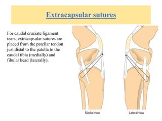 Extracapsular sutures
For caudal cruciate ligament
tears, extracapsular sutures are
placed from the patellar tendon
just distal to the patella to the
caudal tibia (medially) and
fibular head (laterally).
 