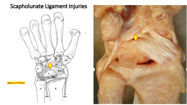 Ligament injuries of hand and wrist