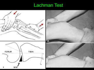 Slide for ligament injury, good for quick reference | PPT