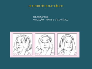 REFLEXO CÓRNEO-PALPEBRALAFERÊNCIA – N. TRIGÊMIOEFERÊNCIA – N. FACIAL E N. TRIGÊMIOAVALIAÇÃO – PONTE E MESENCÉFALO