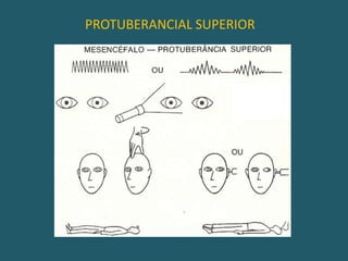 DIENCEFÁLICO TARDIO
