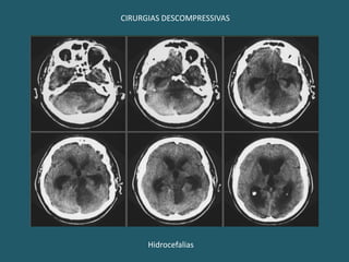 Ausência de sinais focais;