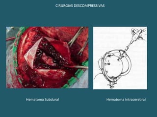 ABORDAGEM1- DIAGNÓSTICO DIFERENCIAL COM PSEUDOCOMA;2 - Transtornos da coluna cervical (trauma);3 - Assegurar respiração;4 - Linha venosa;5 - Condições hemodinâmicas;6 - Glicemia;7 - Sinais de Encefalopatia carencial (vit. B1 parenteral);8 - Se houver suspeita de intoxicação:Benzodiazepínicos » Flumazenil; Narcóticos » Naloxone;9 - Cuidados com pele, olhos, funções fisiológicas, sondas, mobilização, higiene, postura, nutrição;10 - DIAGNÓSTICO ETIOLÓGICO E TRATAMENTO ESPECÍFICO.