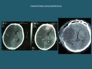 CIRURGIAS DESCOMPRESSIVASHidrocefalias