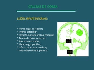 CAUSAS DE COMALESÕES INFRATENTORIAIS:* Hemorragia cerebelar;* Infarto cerebelar;* Hematoma subdural ou epidural;* Tumor de fossa posterior;* Abscesso cerebelar;* Hemorragia pontina;* Infarto de tronco cerebral;* Mielinólise central pontina.