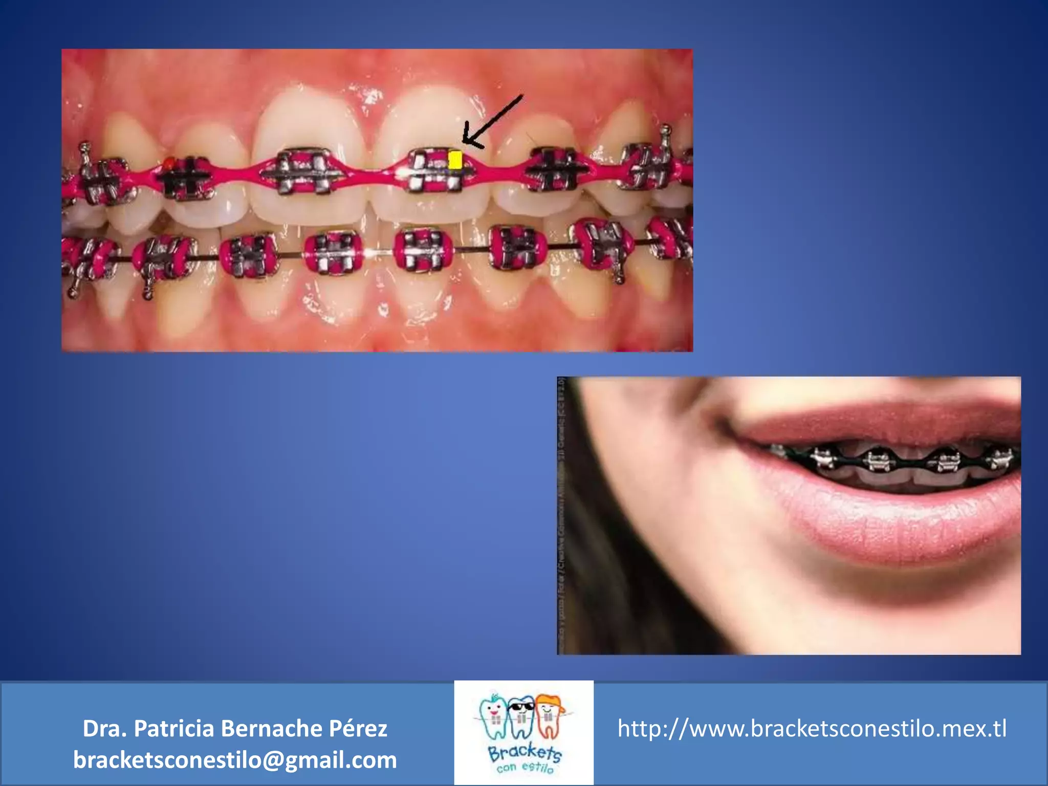 ¿Son Brackets de colores o son ligas de colores? PPT