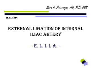 EXTERNAL LIGATION OF INTERNALEXTERNAL LIGATION OF INTERNAL
ILIAC ARTERYILIAC ARTERY
-- E. L. I. I. A.E. L. I. I. A. --
Copyright ©2015, Naira R. (Roland) Matevosyan. All rights reserved.
Naira R. Matevosyan, MD, PhD, JSMNaira R. Matevosyan, MD, PhD, JSM
11.04.201511.04.2015
 