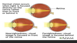 The lens of your eye is a convex lens.
In certain cases, the image falls in front of the retina
because the eyeball is too long. This is called near
sightedness. The lens of a near sighted person is too
convex. A concave lens is used to correct near
sightedness.
If the eyeball is too short, the image is focused behind the
retina. This condition is called farsightedness. The lens of
a farsighted person is not convex enough. The rays of
light converge at a point behind the retina. A convex lens
is used to correct farsightedness.
 