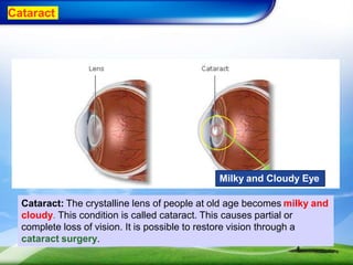 Cataract
Cataract: The crystalline lens of people at old age becomes milky and
cloudy. This condition is called cataract. This causes partial or
complete loss of vision. It is possible to restore vision through a
cataract surgery.
Milky and Cloudy Eye
 