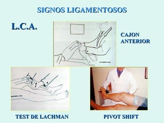 SIGNOS LIGAMENTOSOS L.C.A . CAJON ANTERIOR TEST DE LACHMAN PIVOT SHIFT 