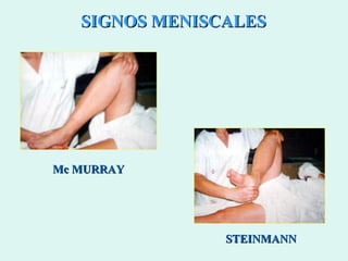 SIGNOS MENISCALES Mc MURRAY STEINMANN 