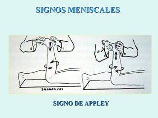 SIGNOS MENISCALES SIGNO DE APPLEY 