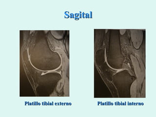 Sagital Platillo tibial interno Platillo tibial externo 
