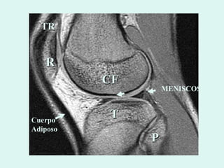 R CF T P TR MENISCOS Cuerpo Adiposo 