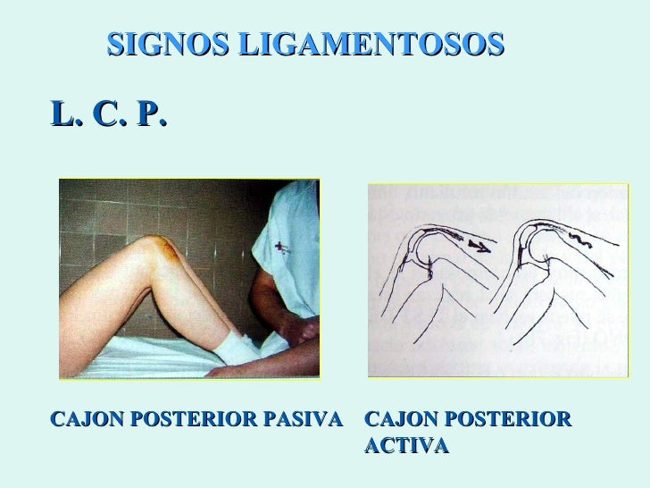 Ligs Cruzados Meniscos