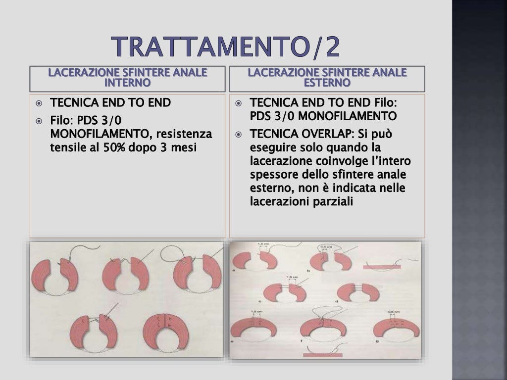 Algoritmo Lacerazioni Perineali III e IV grado Algoritmo Lacerazioni Perineali III e IV grado