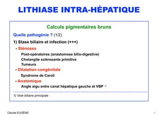 LITHIASE INTRA-HÉPATIQUE
Calculs pigmentaires bruns
Quelle pathogénie ? (1/2)
1) Stase biliaire et infection (+++)
 
- Sté...
