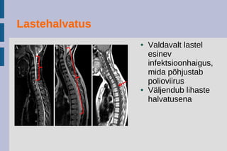 Närvi-lihashaigused
● Tahtele alluvad lihased kehas või neid kontrollivad
närvid on kahjustatud ega tööta seetõttu korralikult
● Kõige sagedamini on kahjustatud käe- ja jalalihaste
talitlus
● Kõige tavalisem sümptom on lihasnõrkus, aga
võimalikud on ka lihaste krambid, kõhetumine
(atroofia) või valud kätes ja jalgades
 