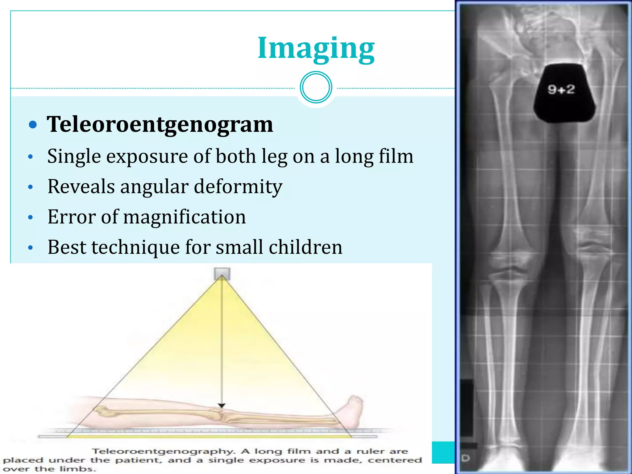 Imaging
 Teleoroentgenogram
• Single exposure of both leg on a long film
• Reveals angular deformity
• Error of magnification
• Best technique for small children
•
 