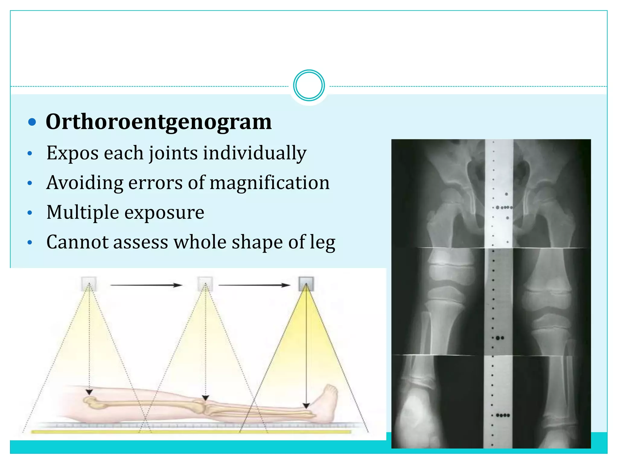  Orthoroentgenogram
• Expos each joints individually
• Avoiding errors of magnification
• Multiple exposure
• Cannot assess whole shape of leg
 